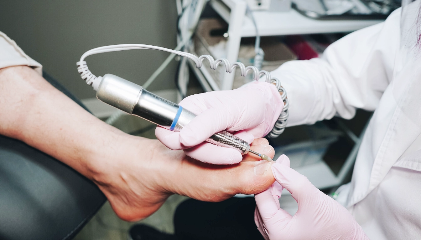 Fungal toenail therapy in Calgary